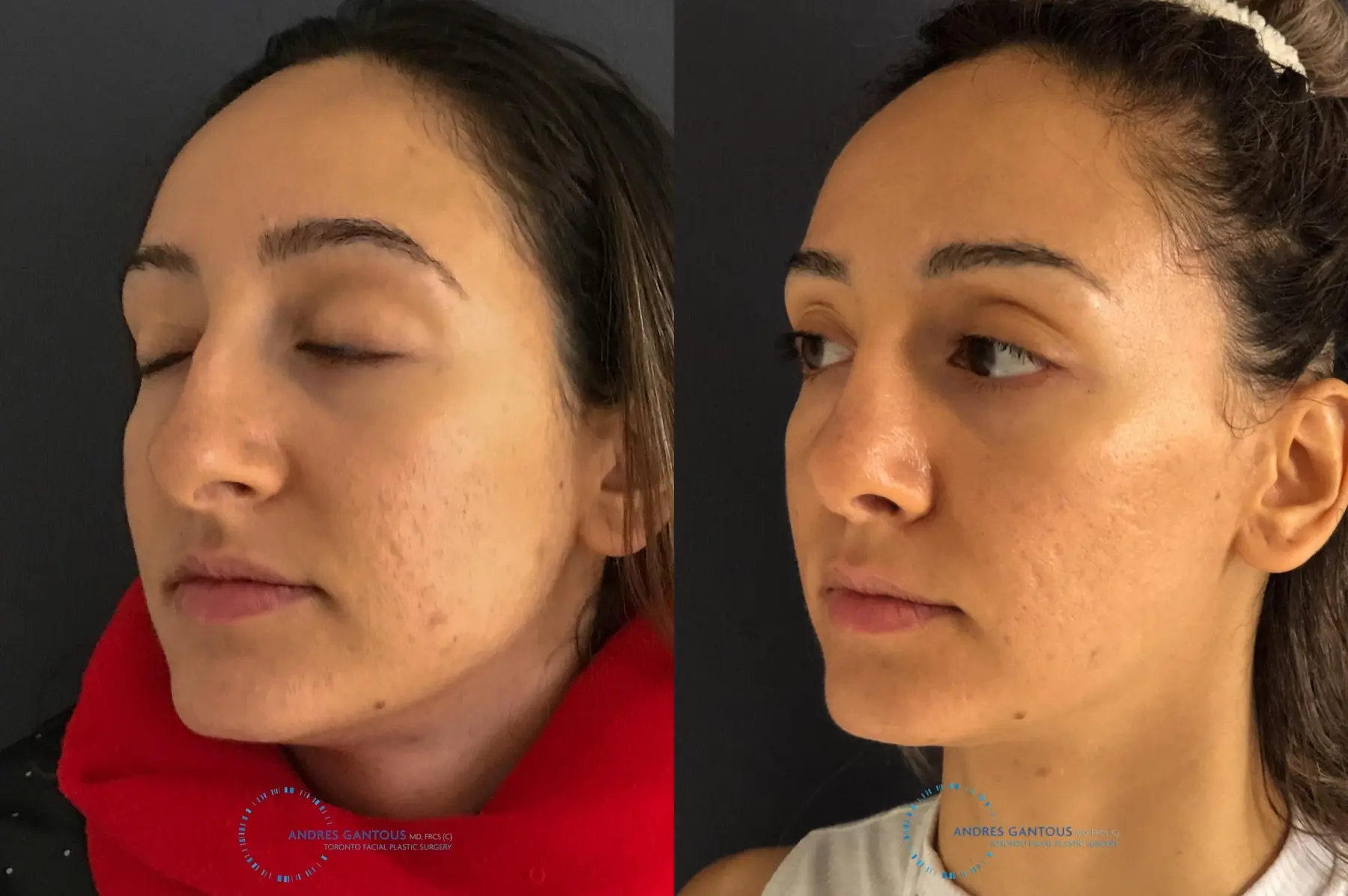 Rhinoplasty: Patient 59 - Before and After 4