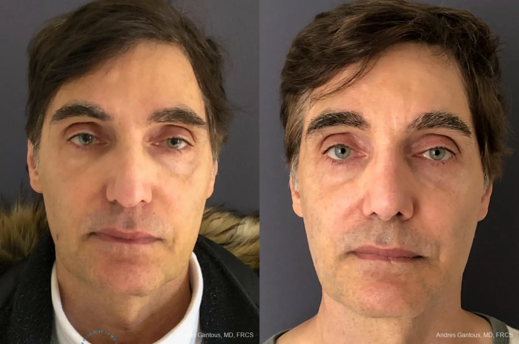 Rhinoplasty: Patient 78 - Before and After 1