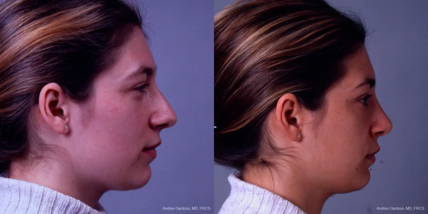 Rhinoplasty: Patient 32 - Before and After 5