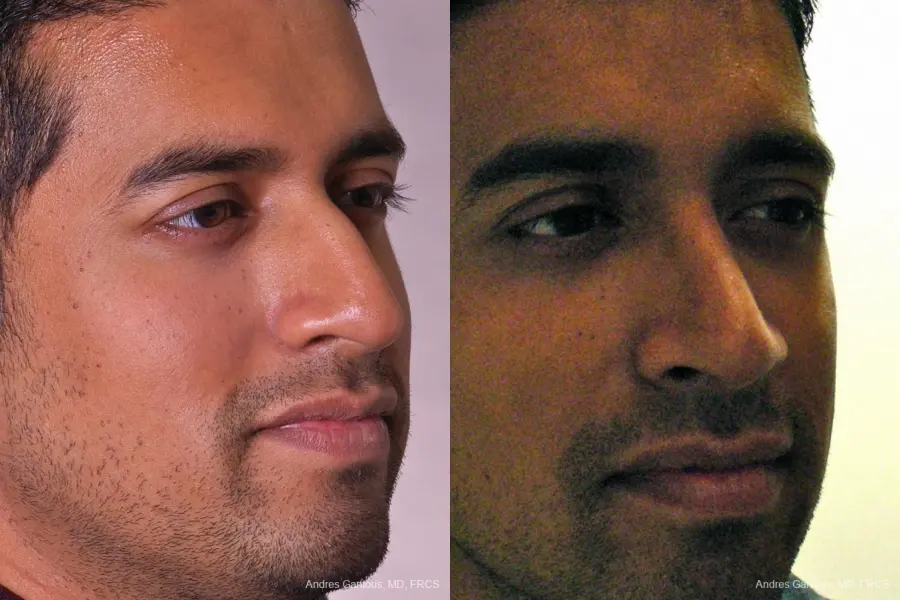 Rhinoplasty: Patient 23 - Before and After 2