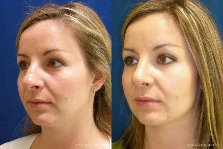 Rhinoplasty: Patient 27 - Before and After 3