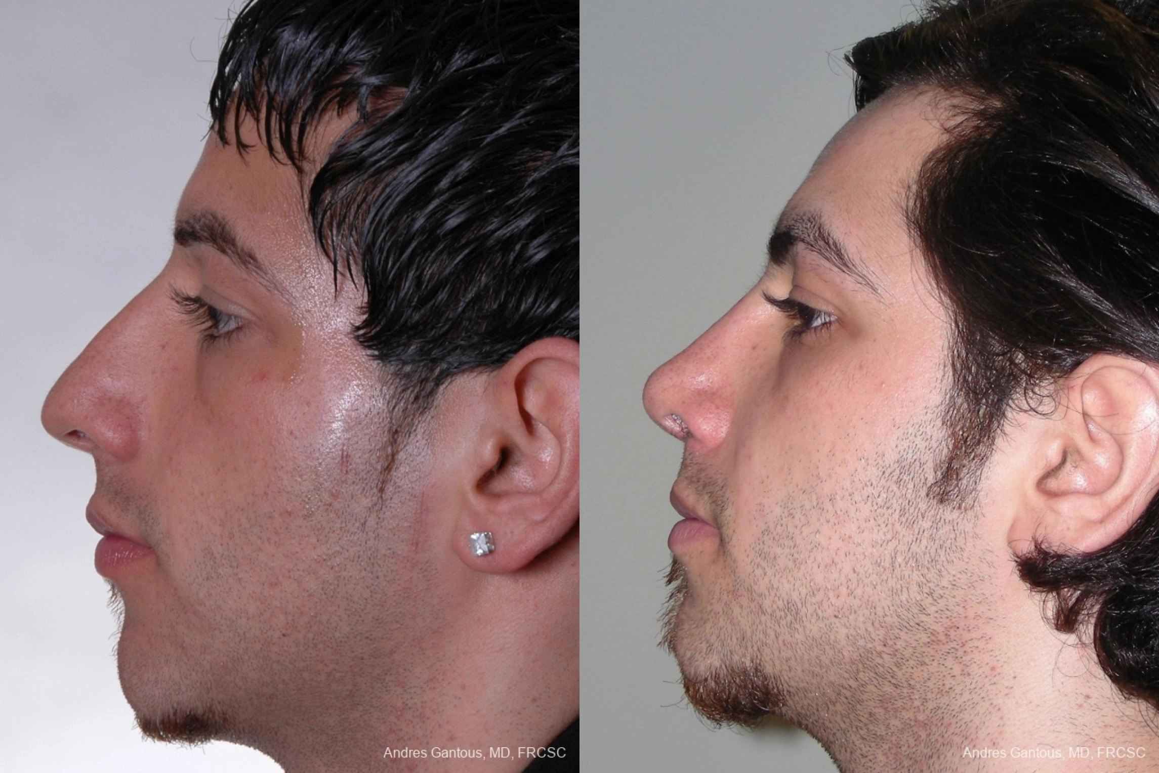 Rhinoplasty - Thumbnail 2