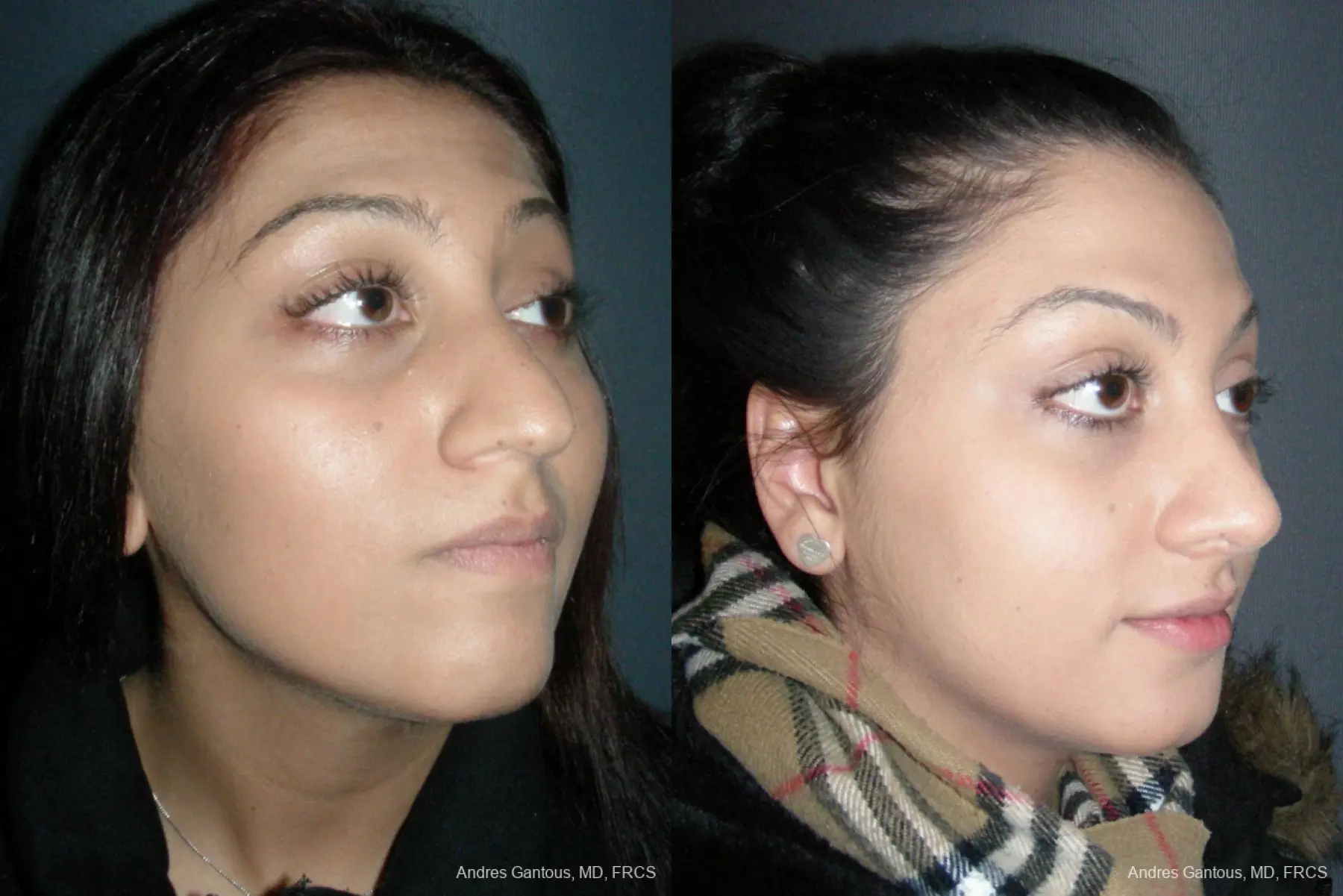 Rhinoplasty: Patient 45 - Before and After 2