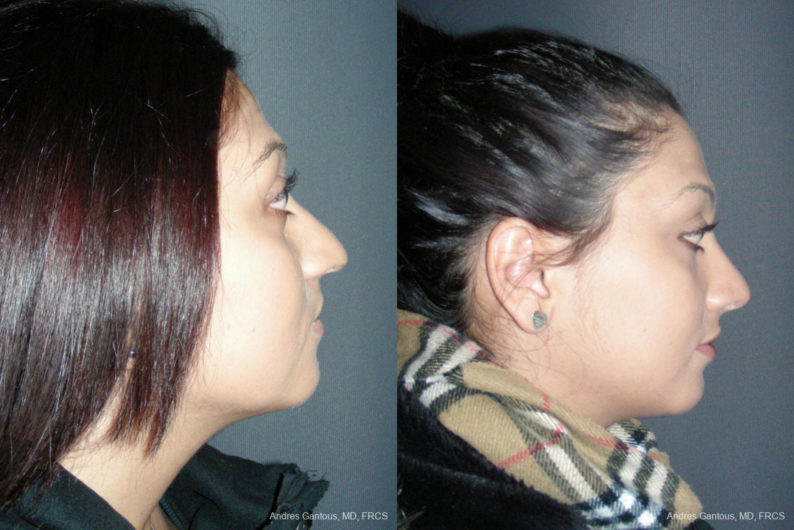 Rhinoplasty - Thumbnail 3
