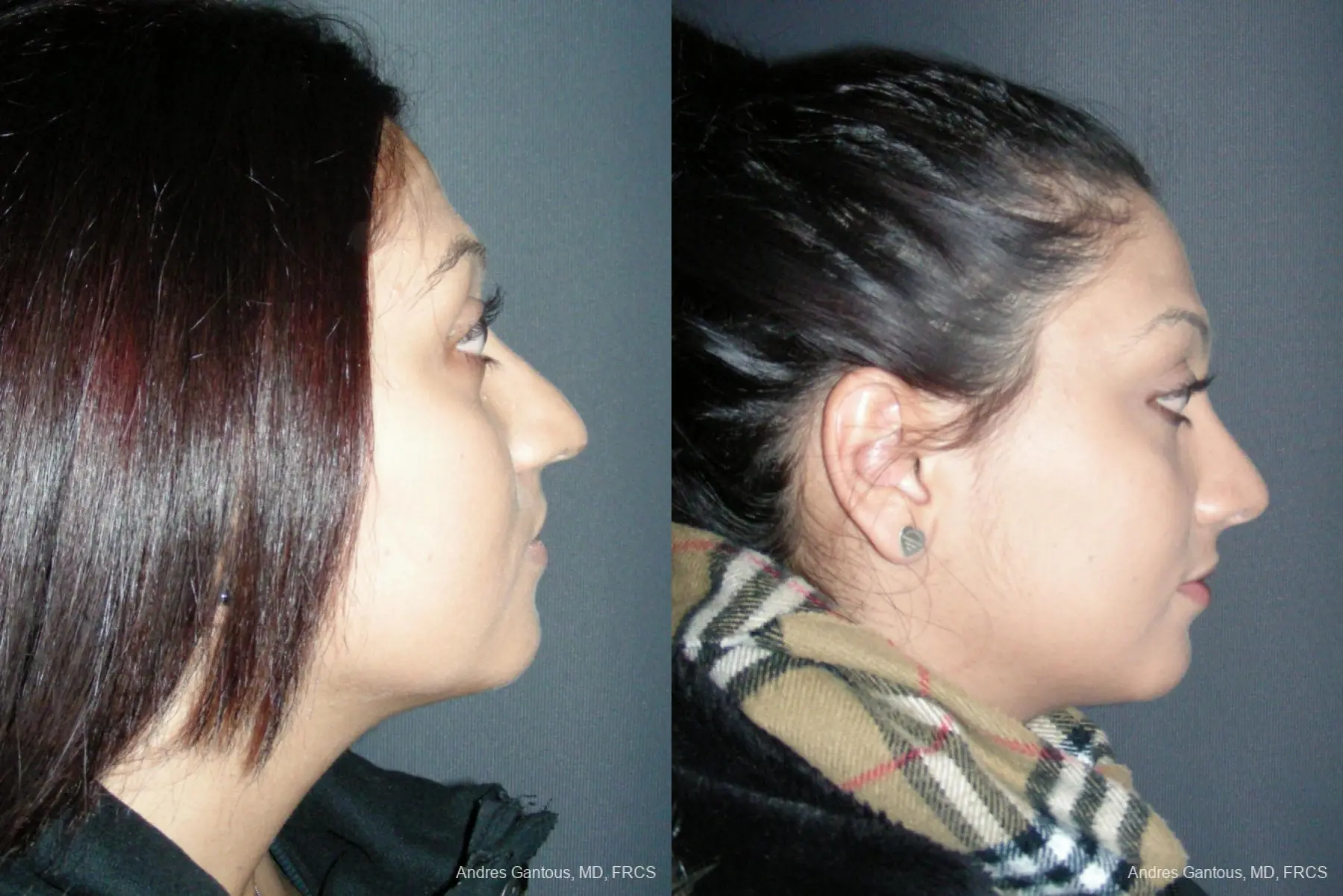 Rhinoplasty: Patient 45 - Before and After 3