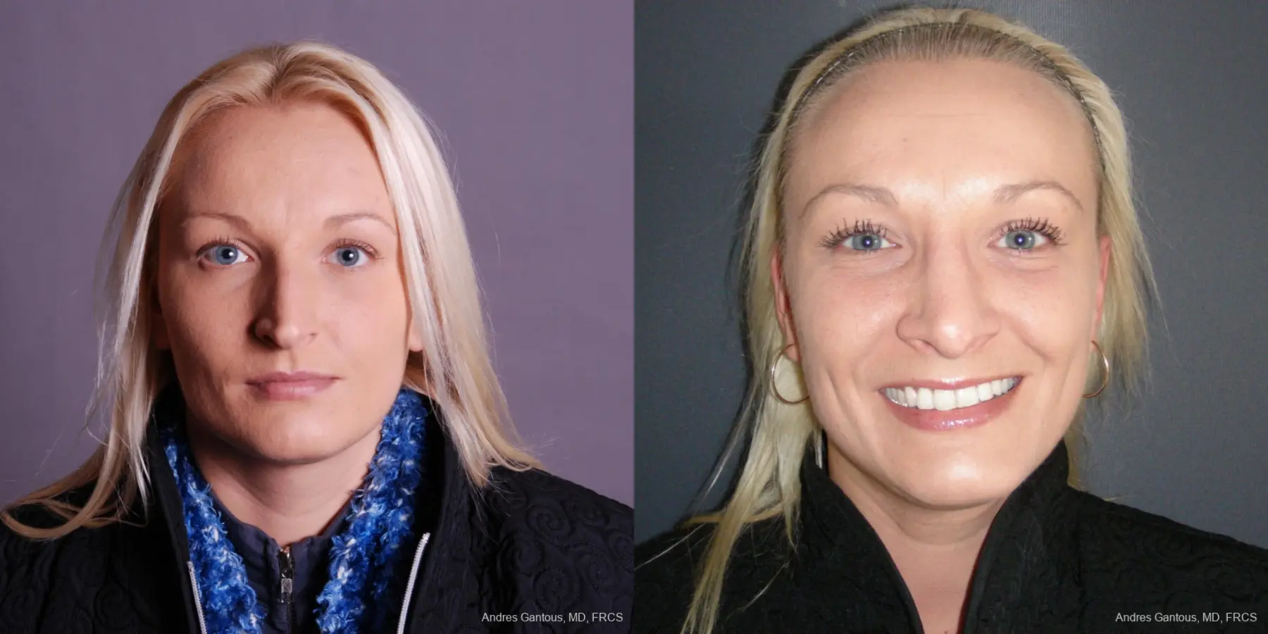 Rhinoplasty: Patient 48 - Before and After  