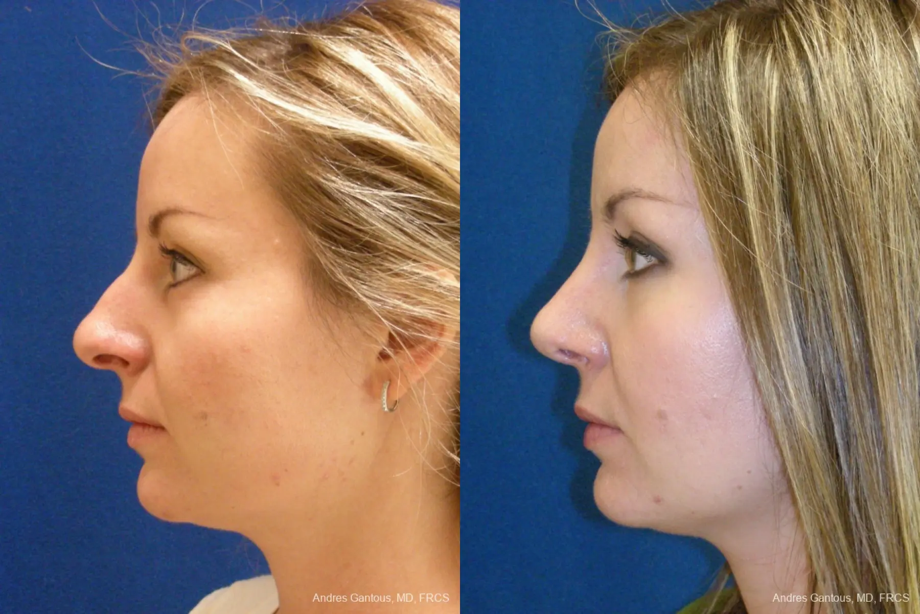 Rhinoplasty: Patient 27 - Before and After 5