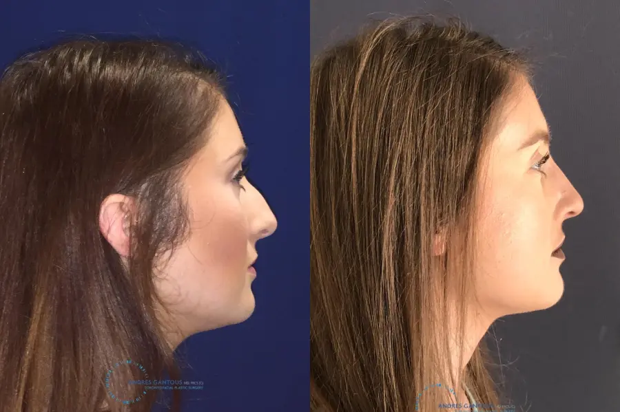 Rhinoplasty: Patient 1 - Before and After 6