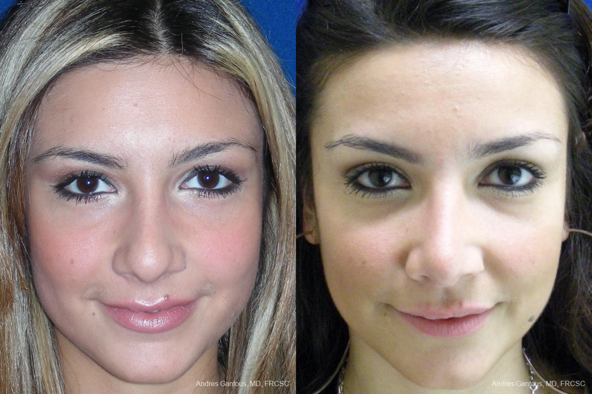 Nose Procedures - Case 11618