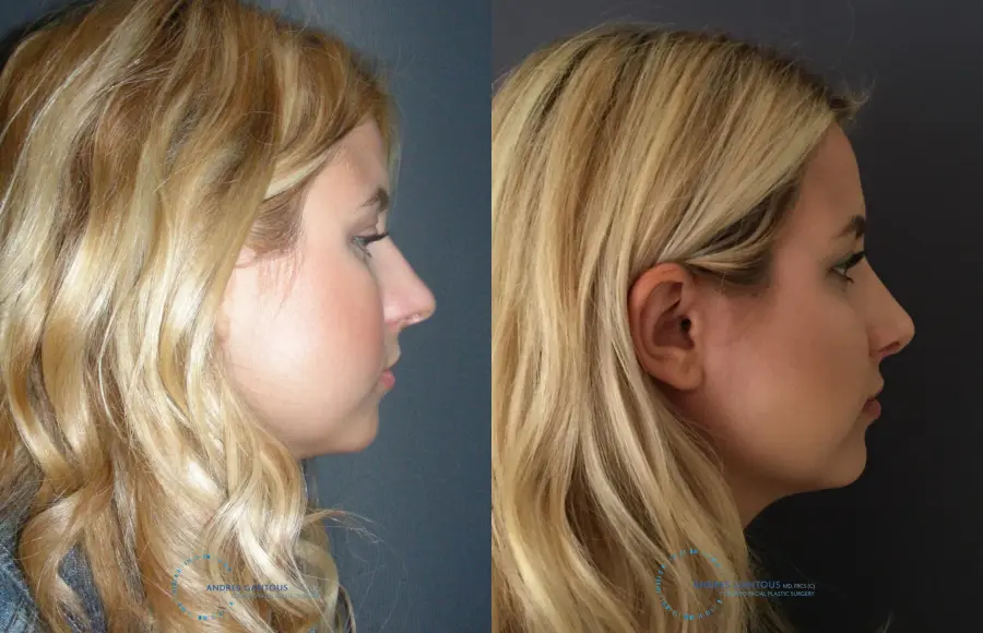 Rhinoplasty: Patient 70 - Before and After 5