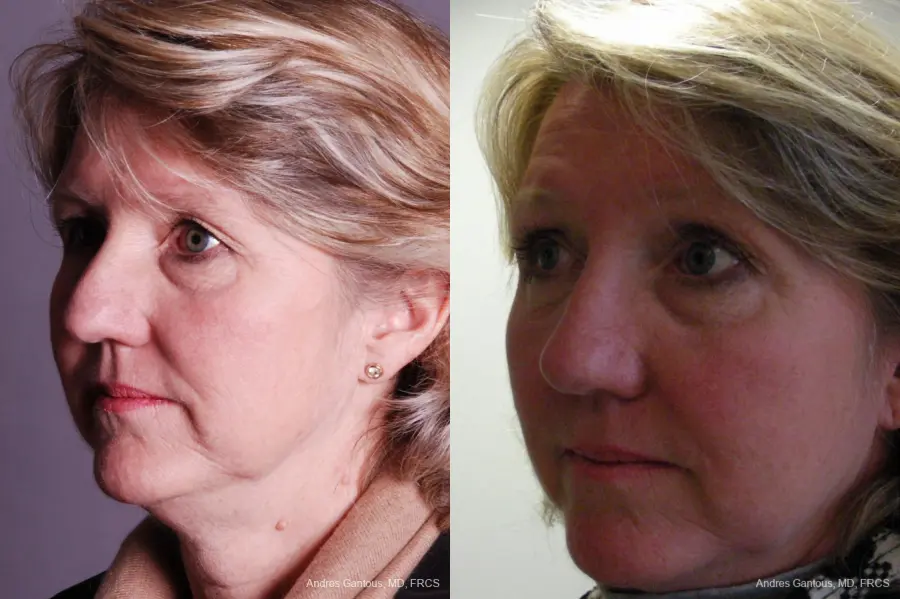 Rhinoplasty: Patient 18 - Before and After 2