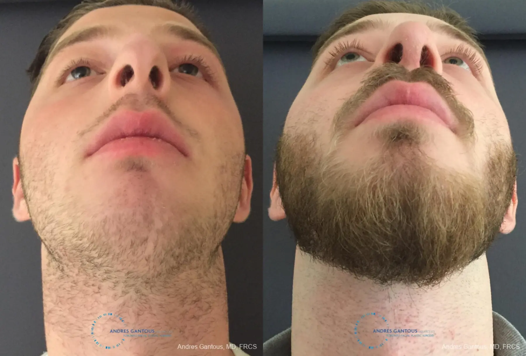 Rhinoplasty: Patient 96 - Before and After 2