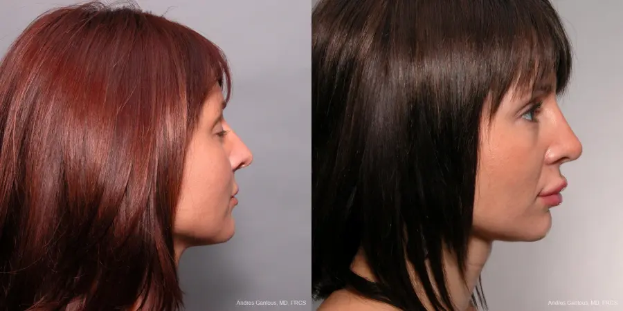 Rhinoplasty: Patient 36 - Before and After 2
