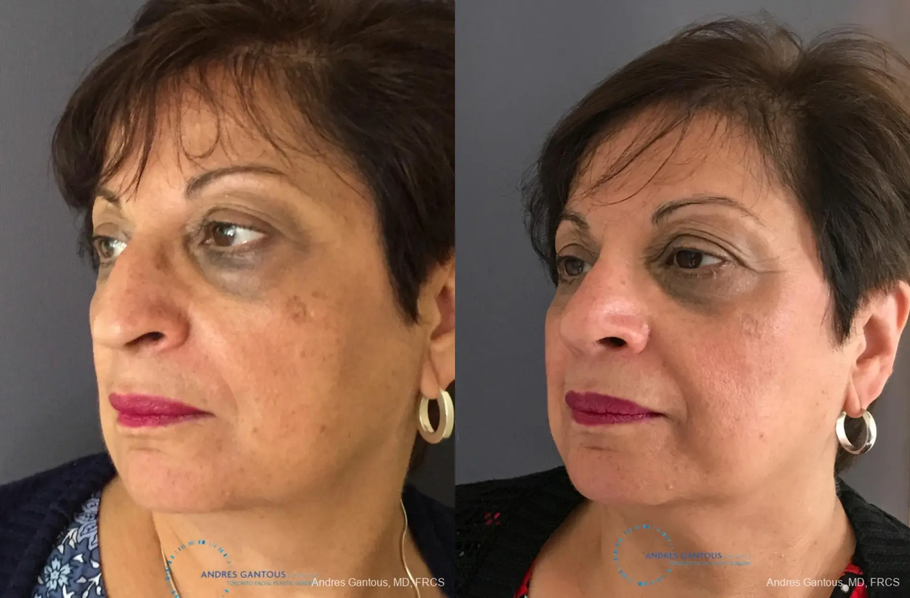 Rhinoplasty: Patient 91 - Before and After 4