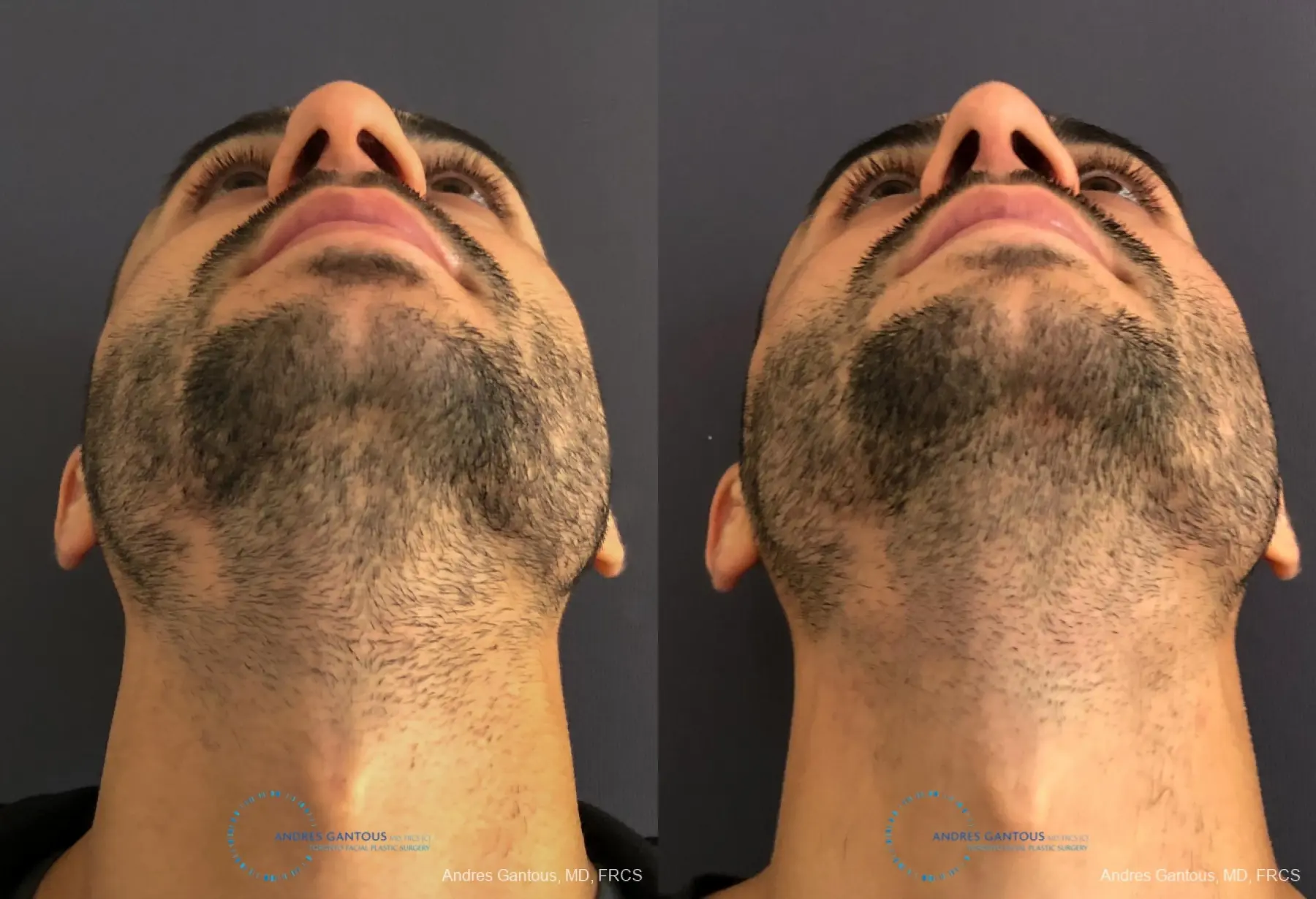 Rhinoplasty: Patient 89 - Before and After 2
