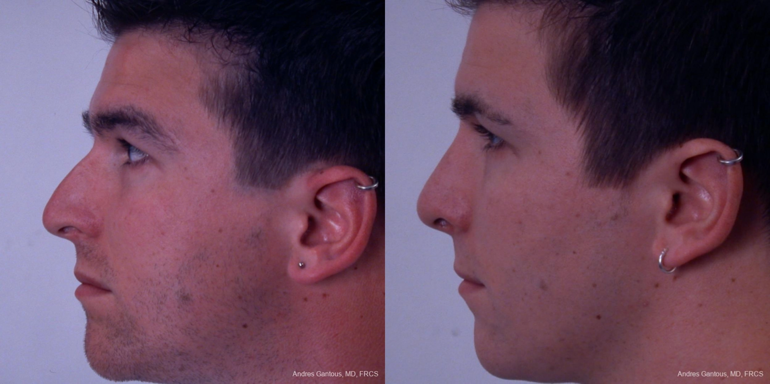 Rhinoplasty - Thumbnail 2