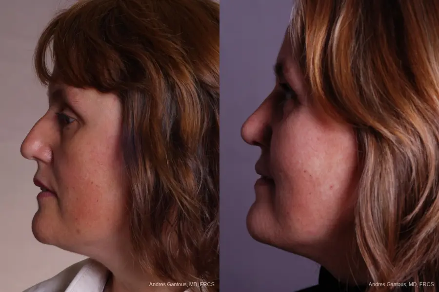 Rhinoplasty: Patient 40 - Before and After 5