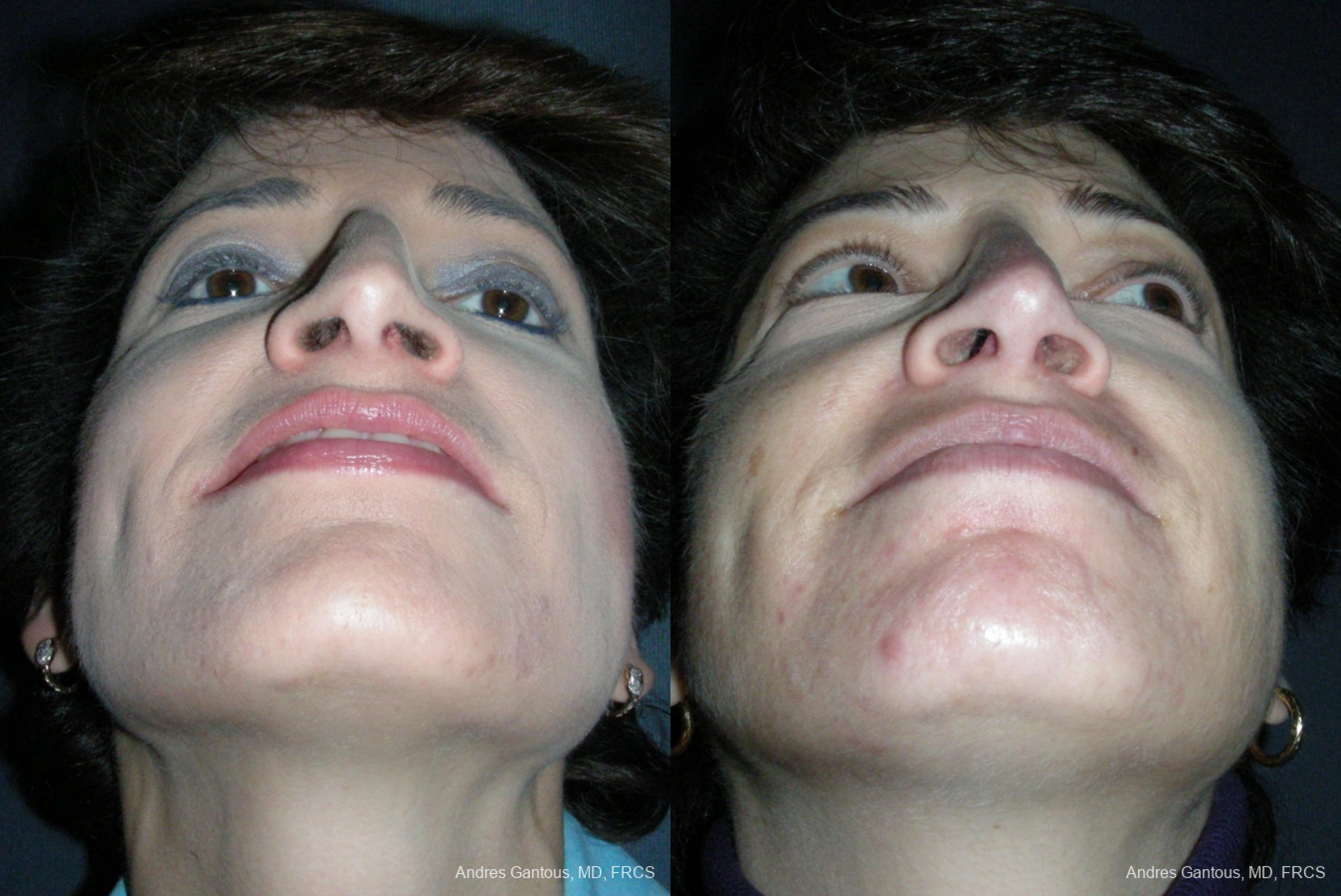 Rhinoplasty - Thumbnail 6