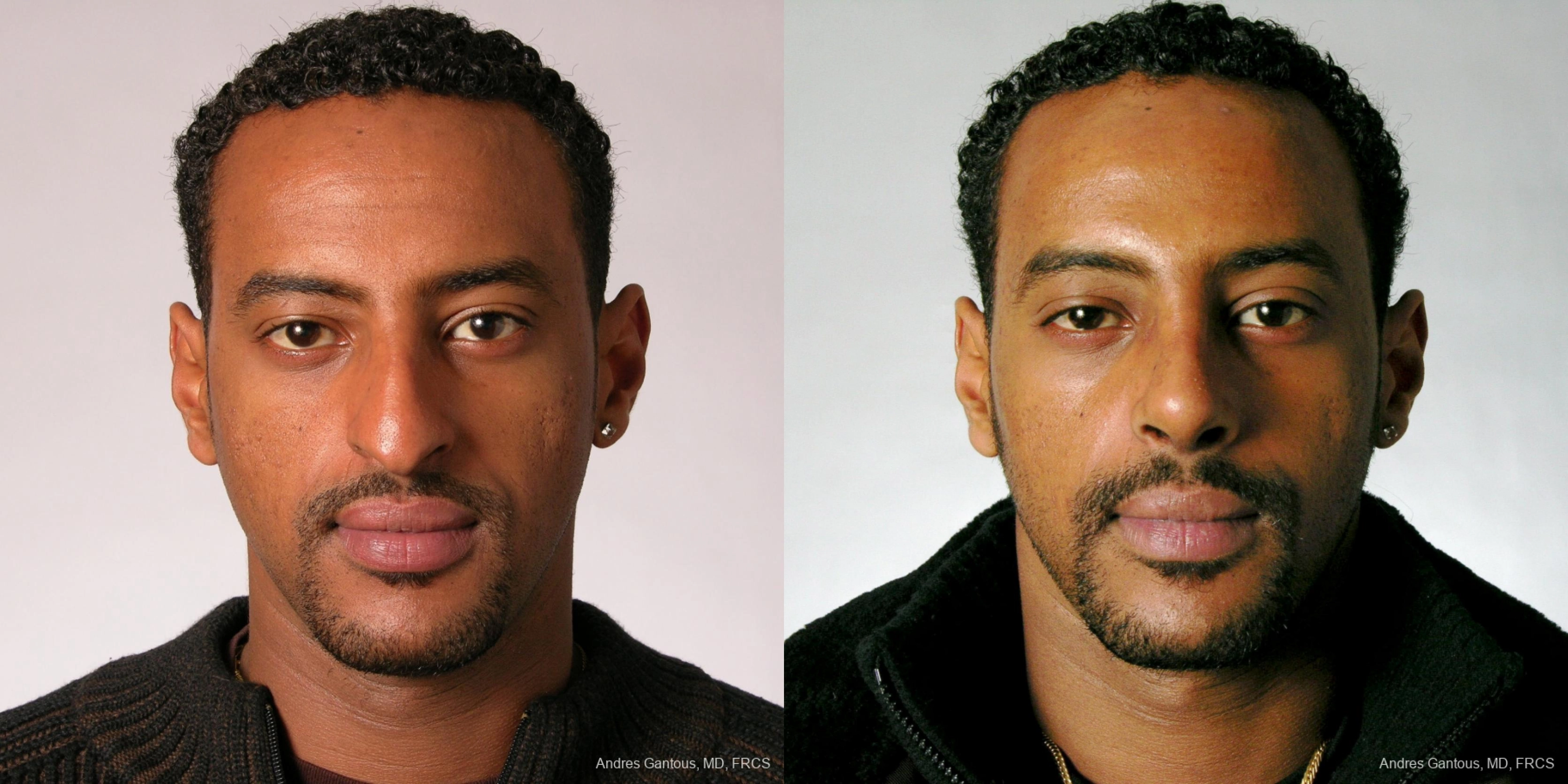 Rhinoplasty - Case 6688