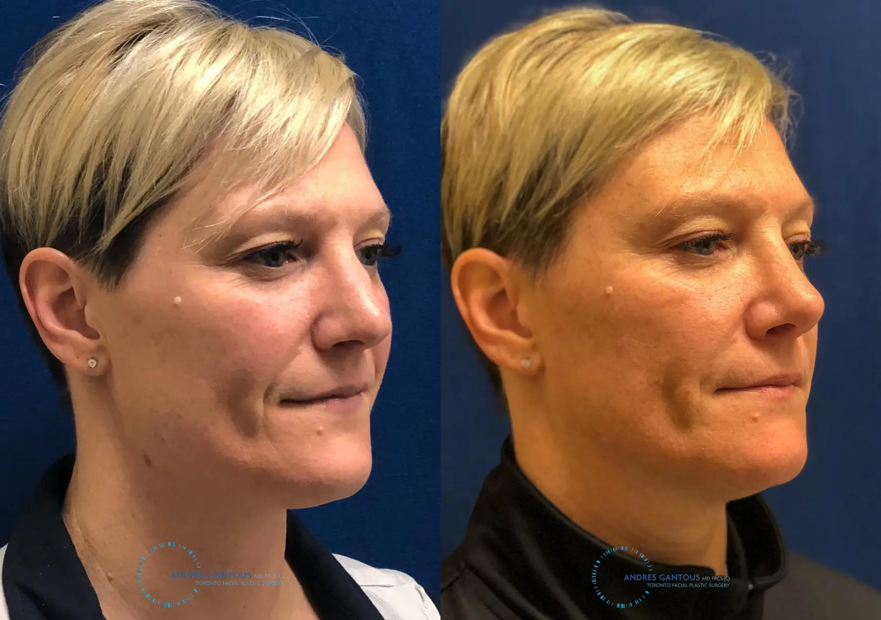 Rhinoplasty: Patient 68 - Before and After 3