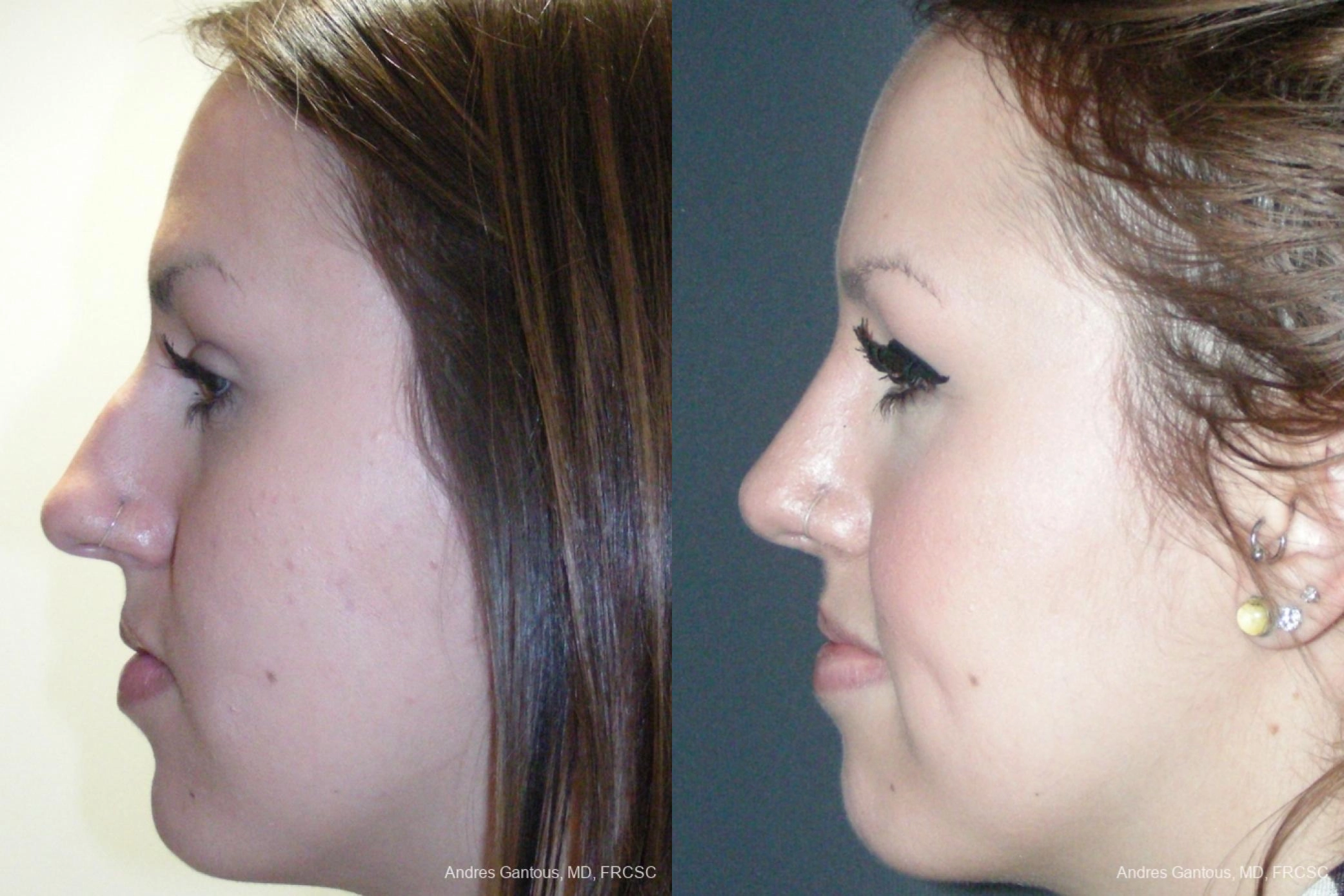 Rhinoplasty - Thumbnail 4