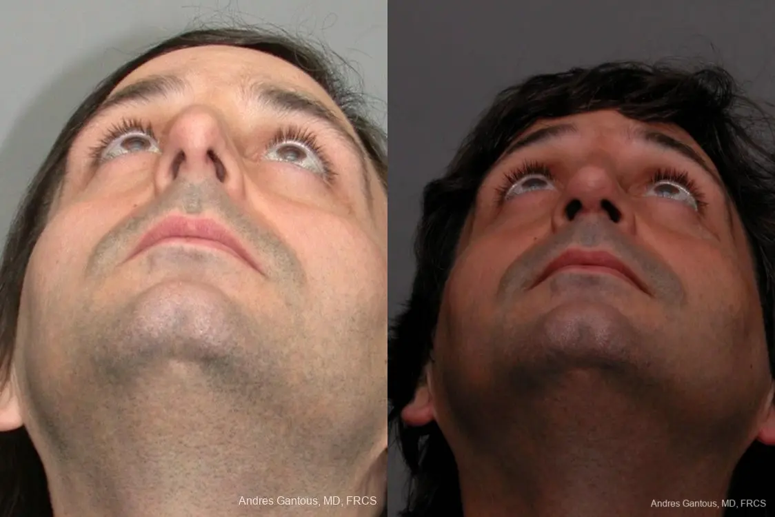 Rhinoplasty: Patient 17 - Before and After 4