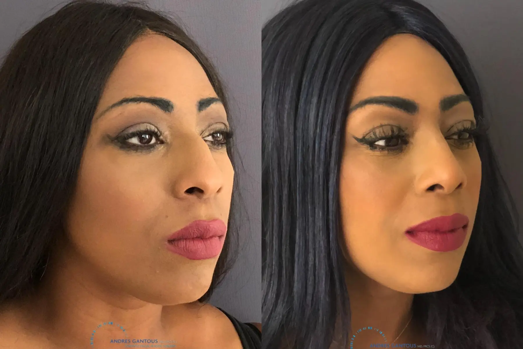 Rhinoplasty: Patient 66 - Before and After 4