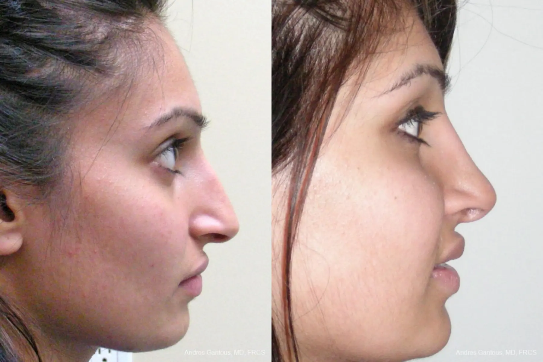 Rhinoplasty: Patient 28 - Before and After 5
