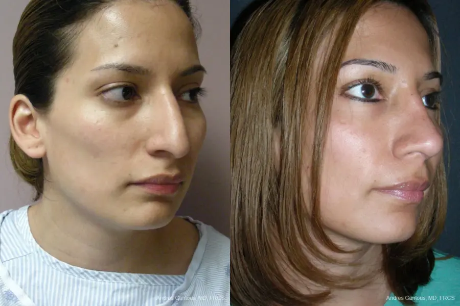 Rhinoplasty: Patient 56 - Before and After 2