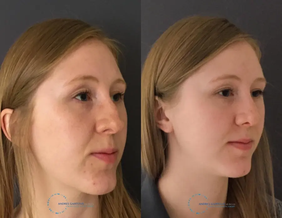 Rhinoplasty: Patient 26 - Before and After 4