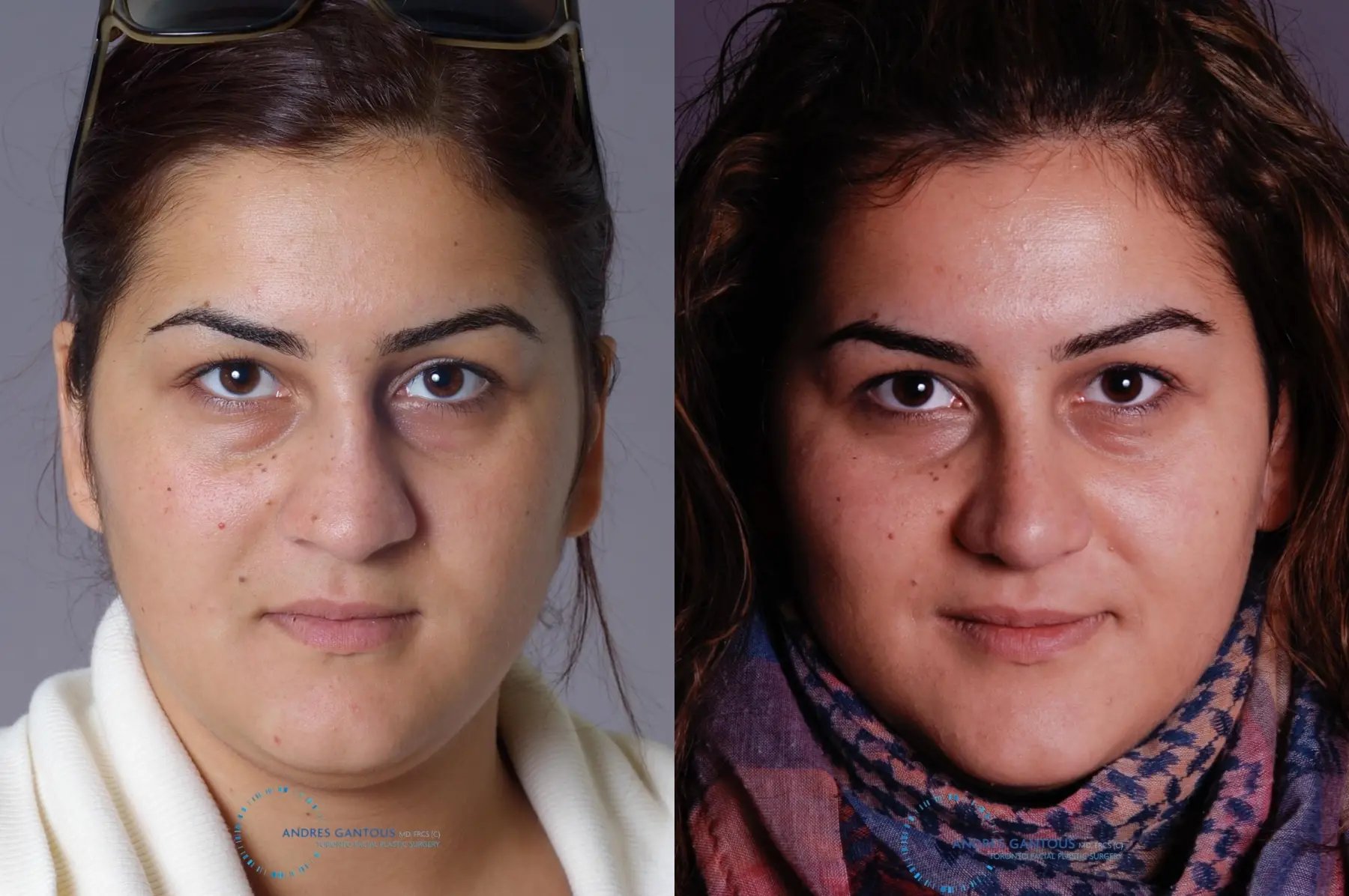 Rhinoplasty: Patient 69 - Before and After 1