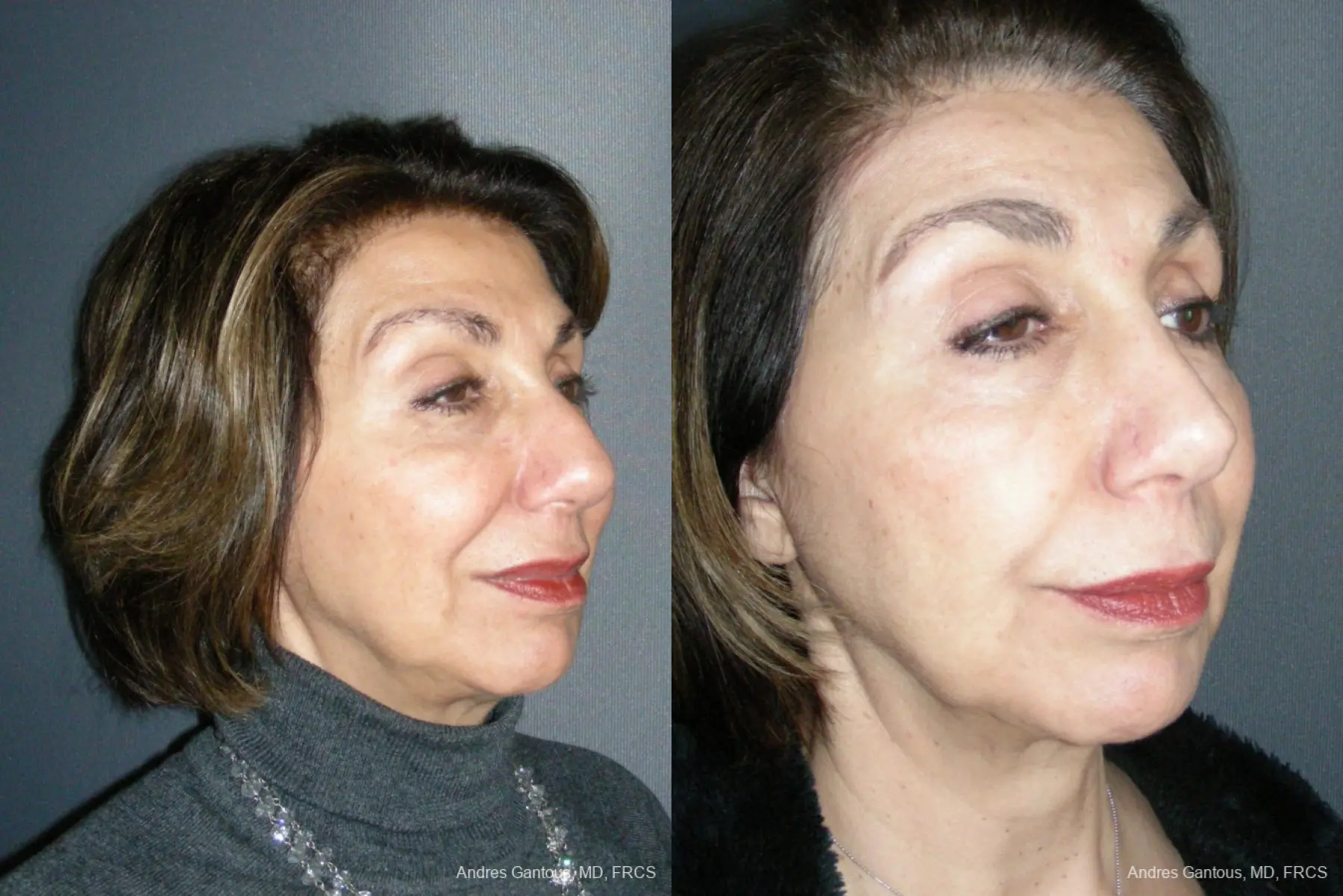 Rhinoplasty: Patient 53 - Before and After 4