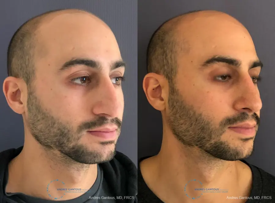 Rhinoplasty: Patient 89 - Before and After 3
