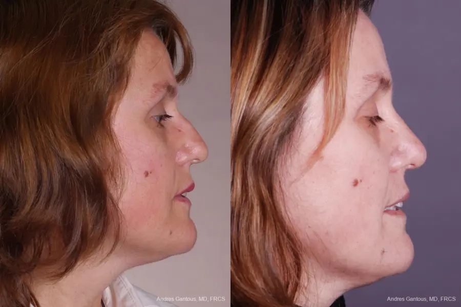 Rhinoplasty: Patient 40 - Before and After 3