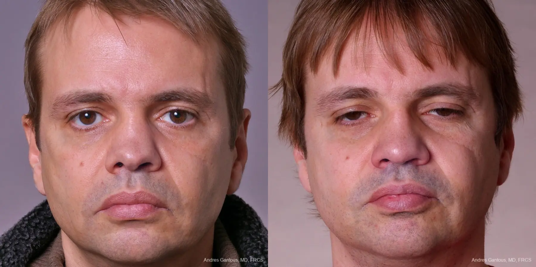 Rhinoplasty: Patient 38 - Before and After 1