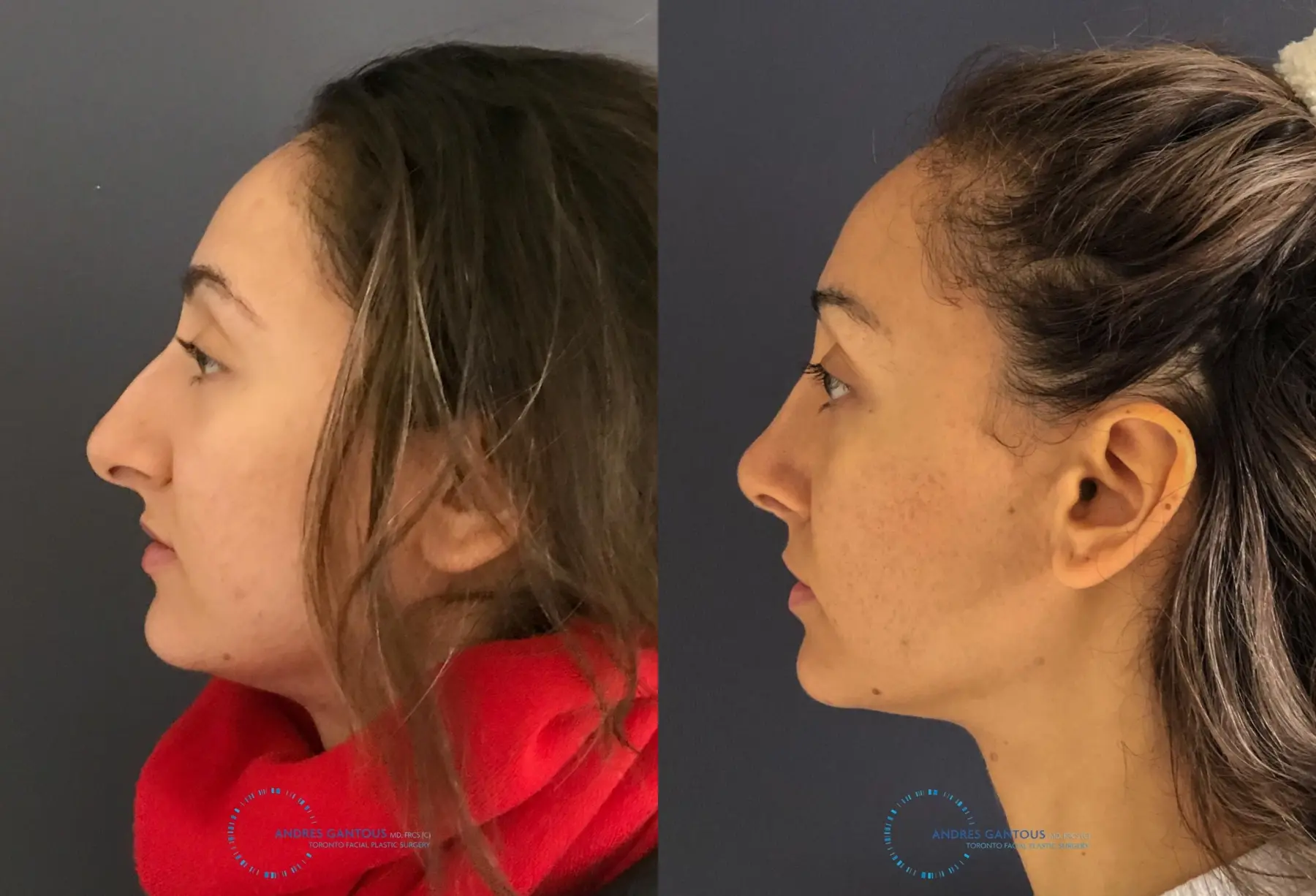 Rhinoplasty: Patient 59 - Before and After 6