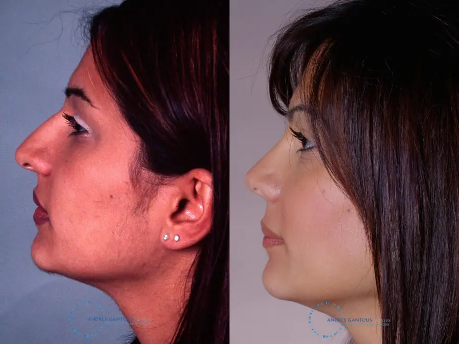 Rhinoplasty: Patient 31 - Before and After 4