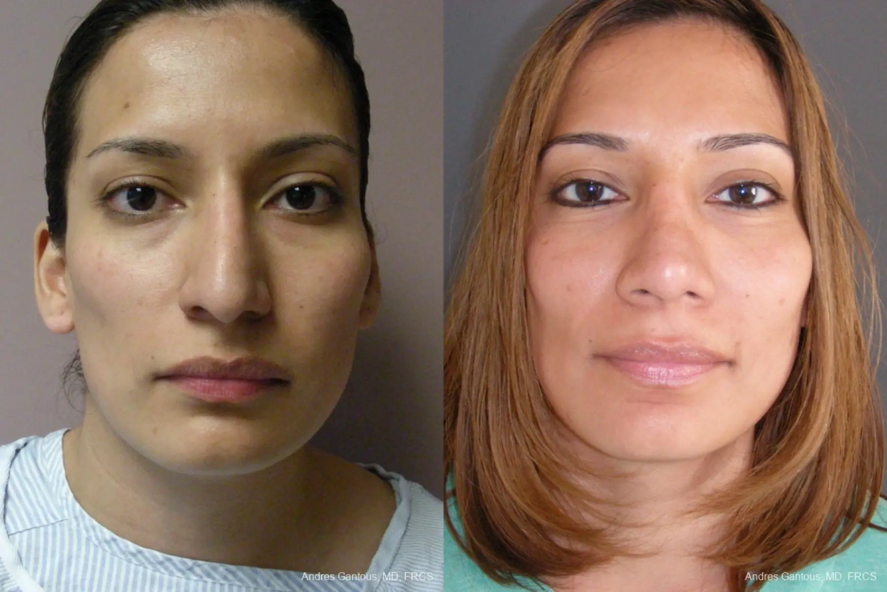 Rhinoplasty: Patient 56 - Before and After 1
