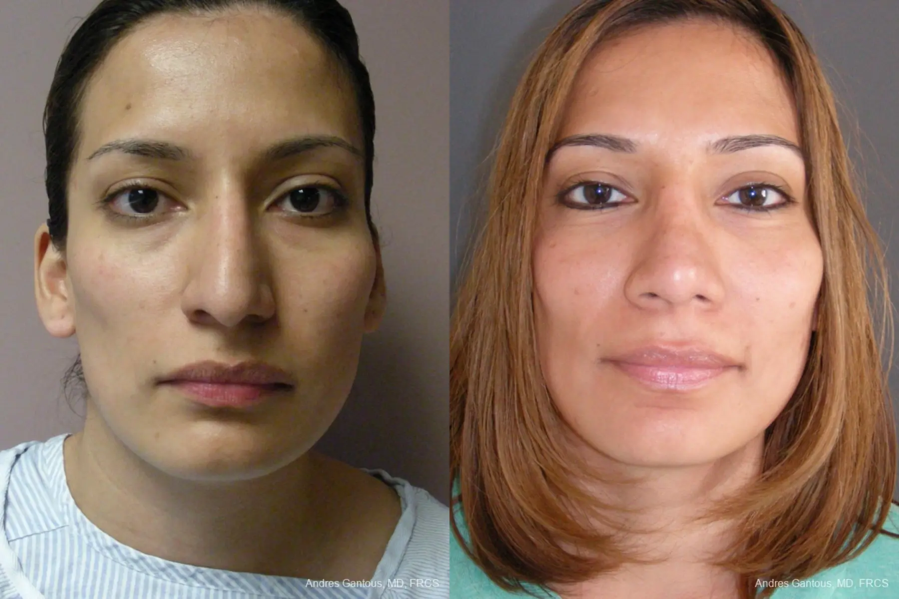 Rhinoplasty: Patient 56 - Before and After  