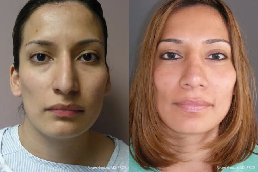 Rhinoplasty: Patient 56 - Before and After 1
