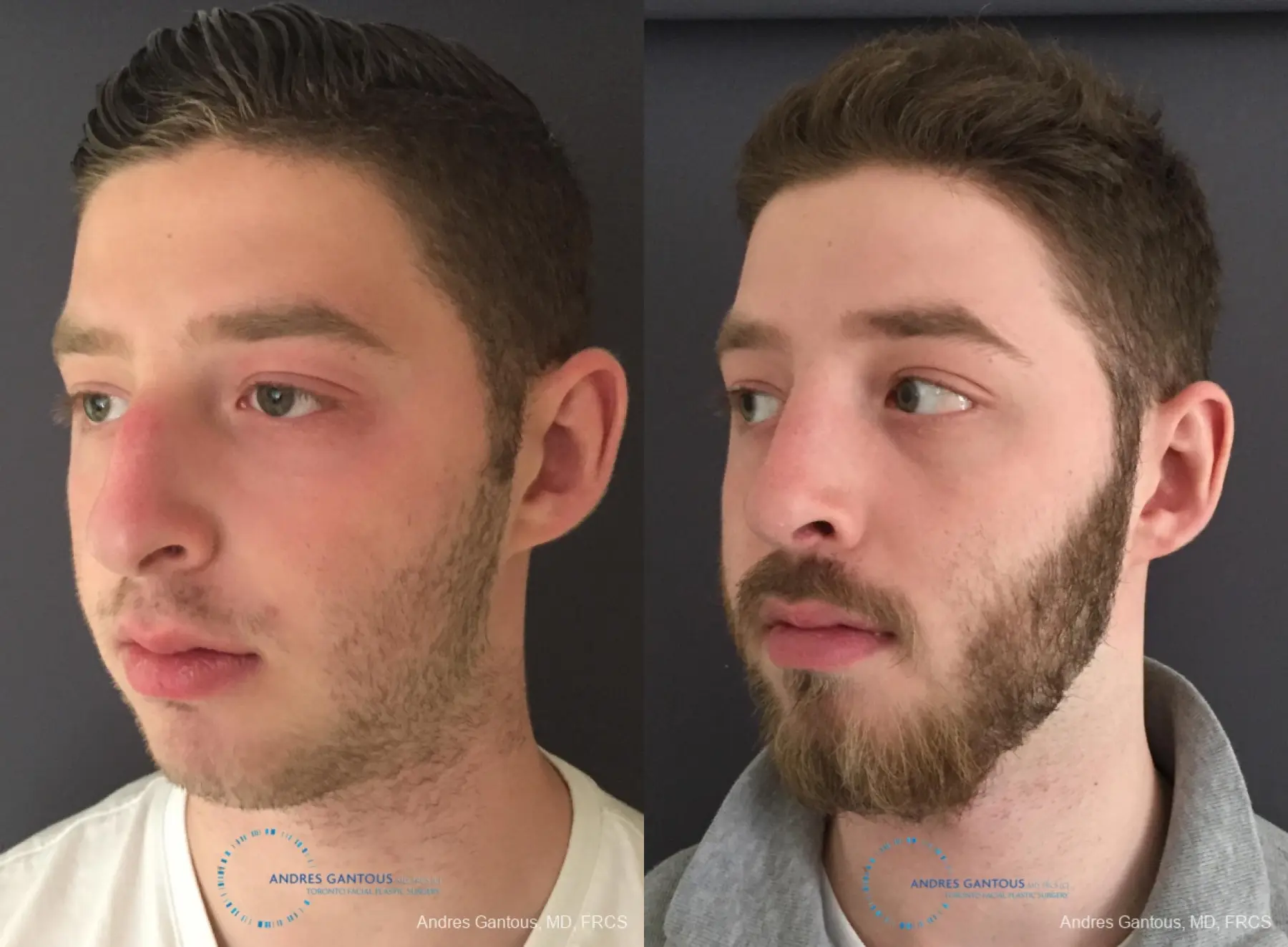 Rhinoplasty: Patient 96 - Before and After 4