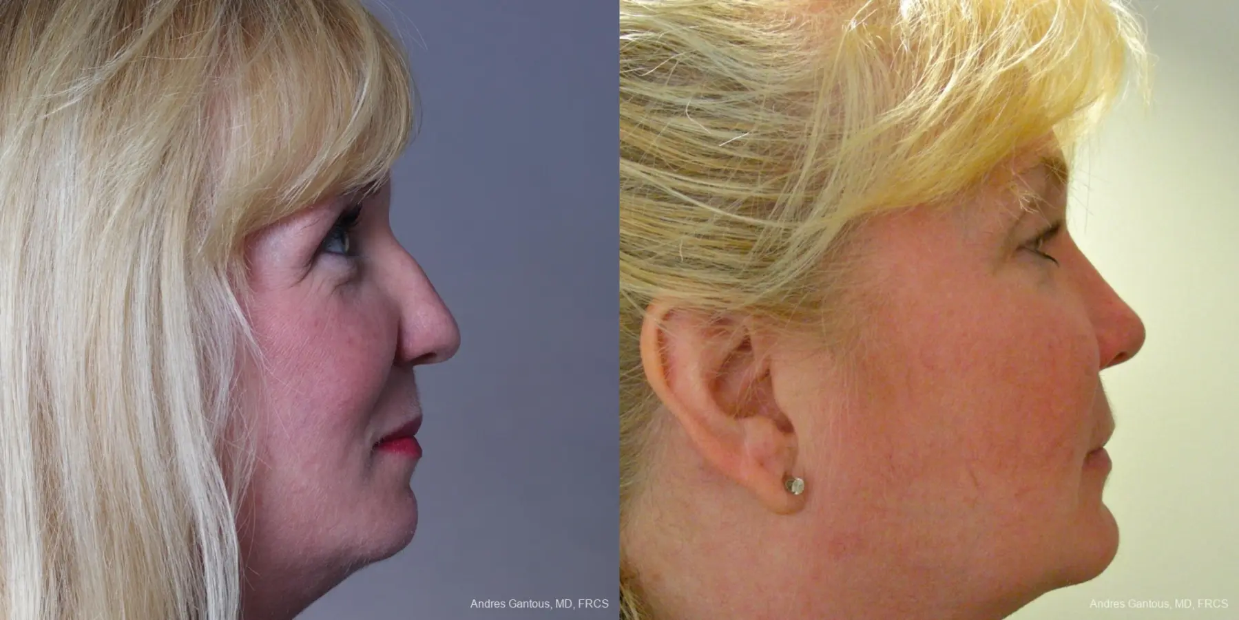 Rhinoplasty: Patient 37 - Before and After 4