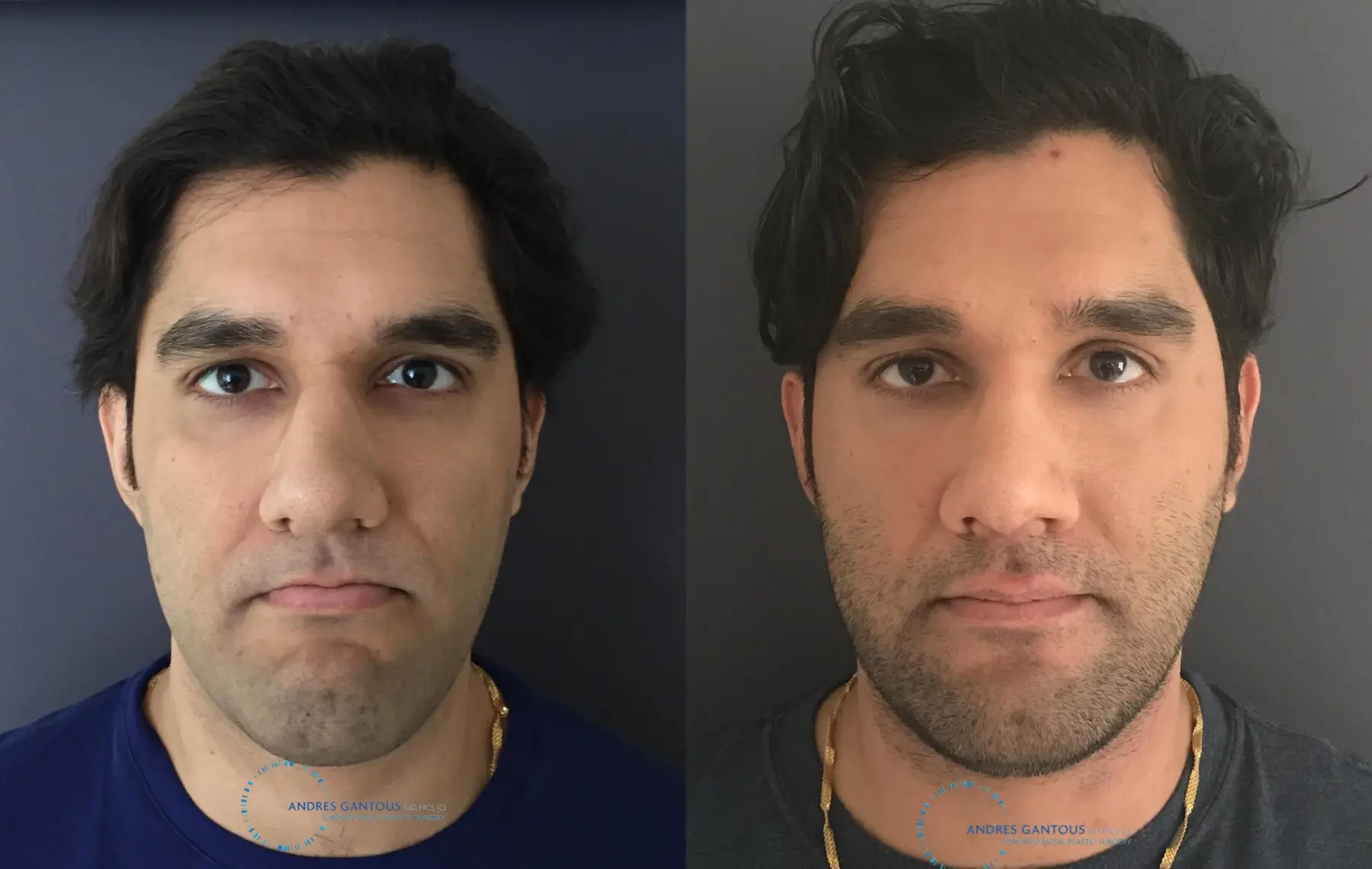 Rhinoplasty: Patient 60 - Before and After 1