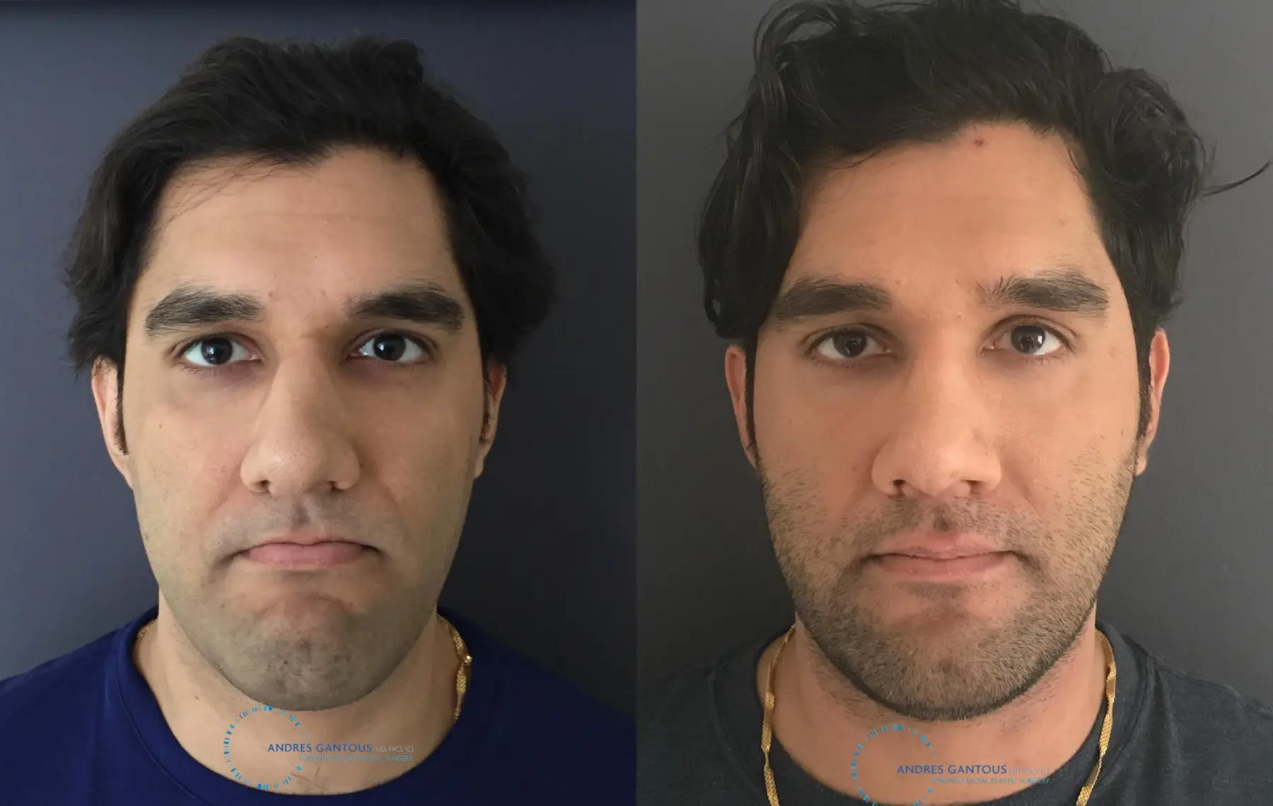 Rhinoplasty: Patient 60 - Before and After  