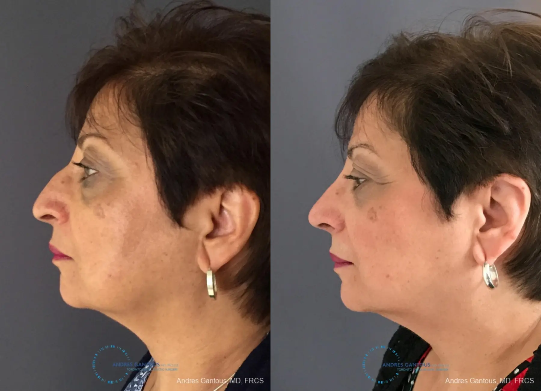 Rhinoplasty: Patient 91 - Before and After 6