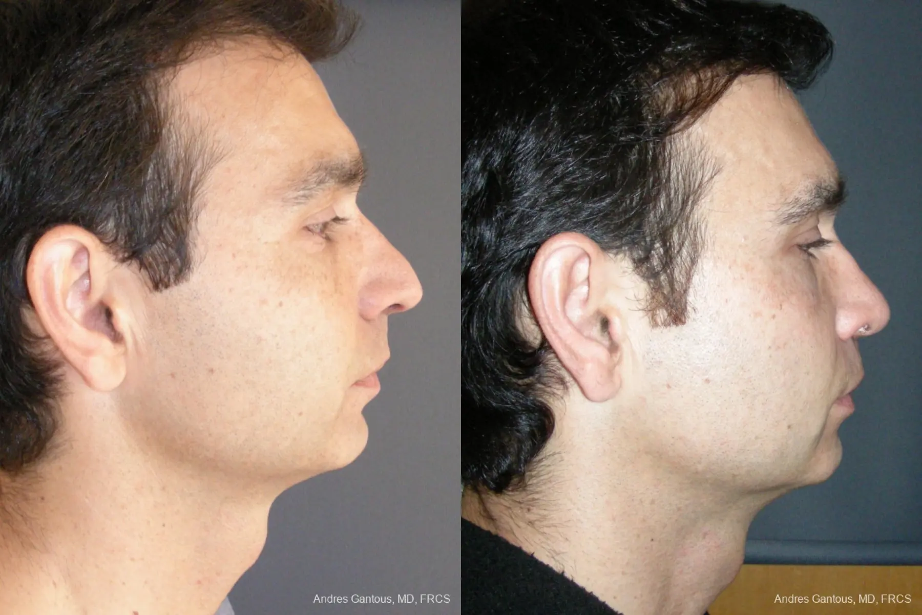 Rhinoplasty: Patient 43 - Before and After 3