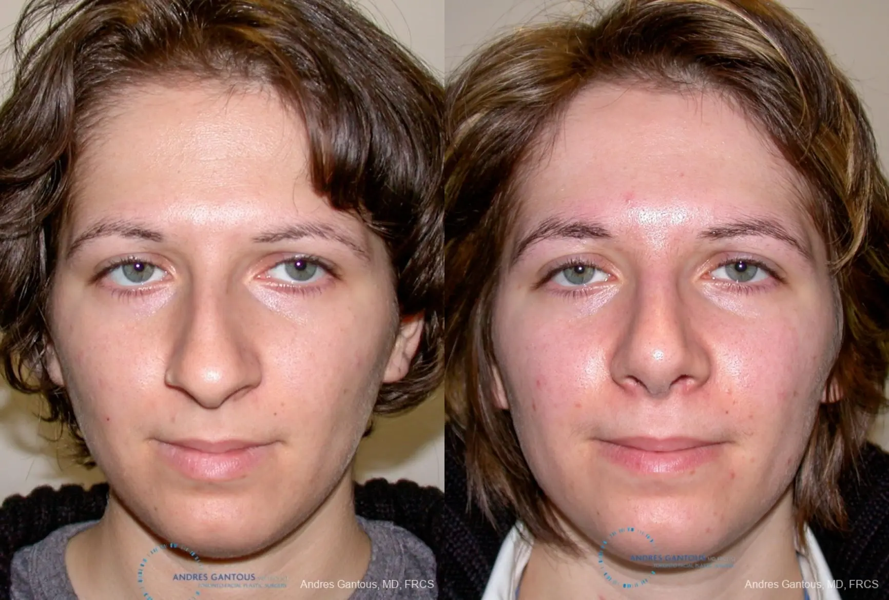 Rhinoplasty: Patient 88 - Before and After 1