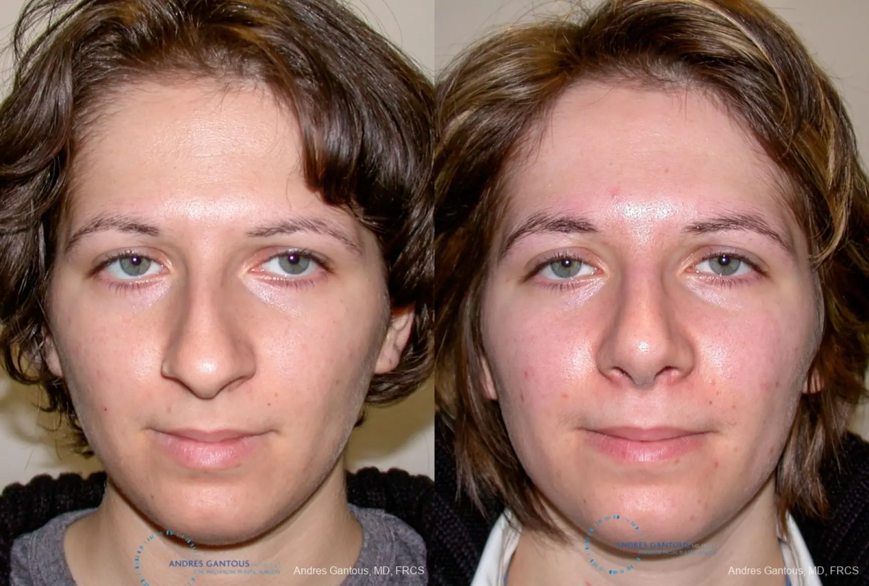 Rhinoplasty: Patient 88 - Before and After  