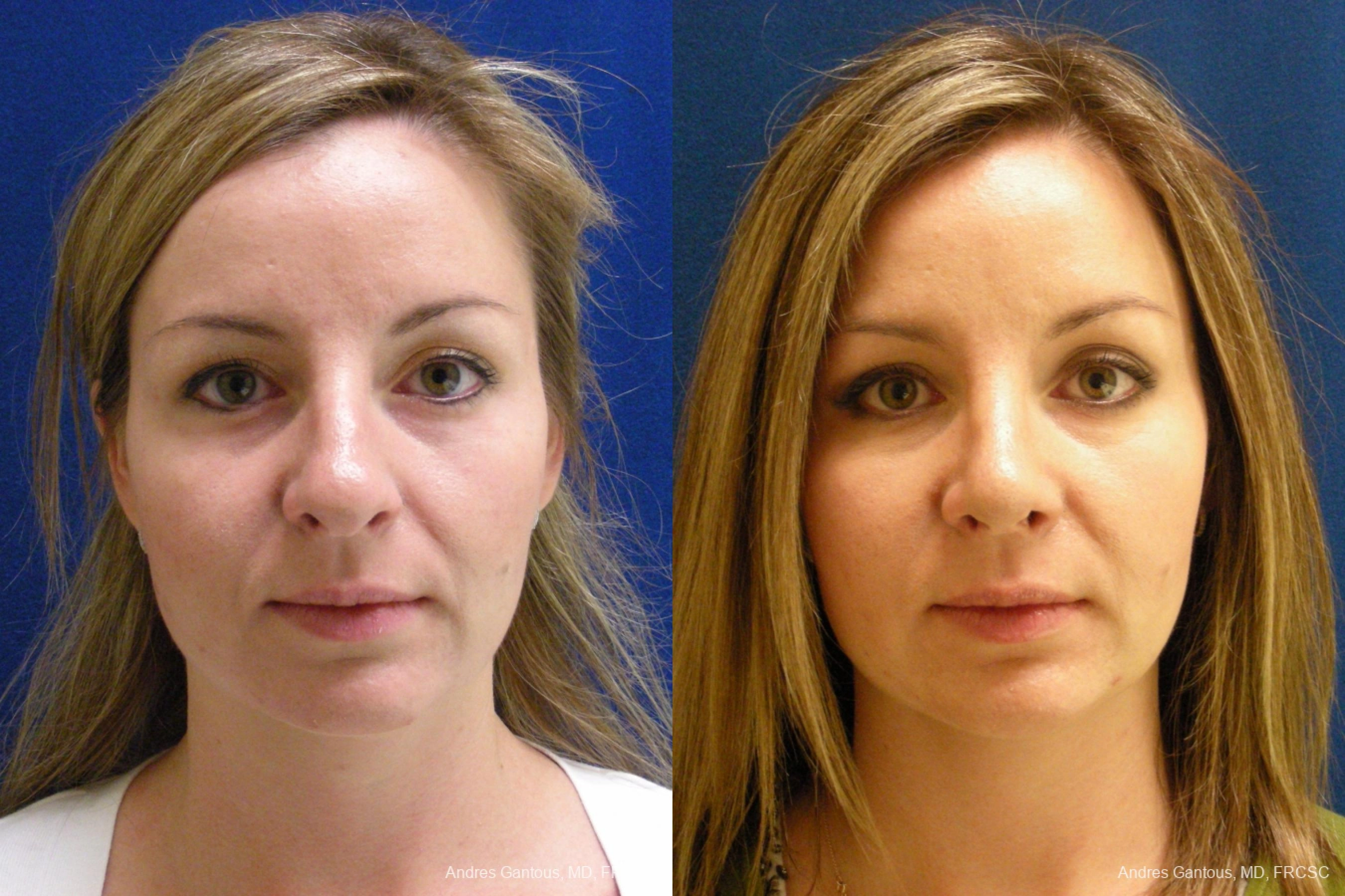 Nose Procedures - Case 11615