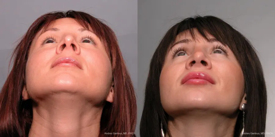Rhinoplasty: Patient 36 - Before and After 4